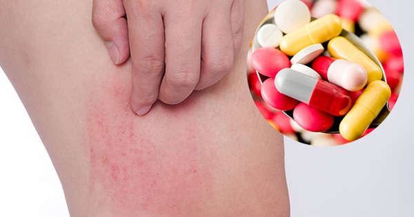 cách chữa dị ứng thuốc tây tại nhà