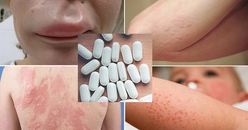 Cách chữa dị ứng thuốc tây tại nhà