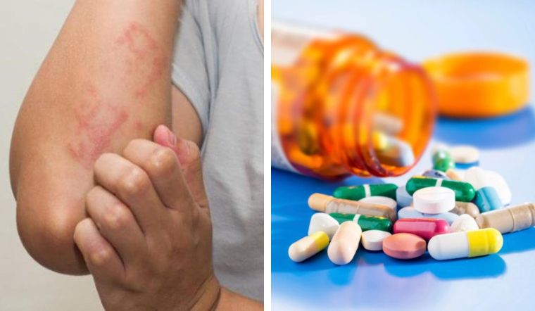 cách chữa dị ứng thuốc tây tại nhà