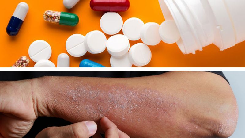 cách chữa dị ứng thuốc tây tại nhà