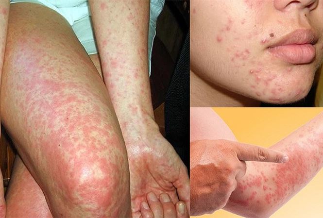 Dị Ứng Thời Tiết Lạnh Nổi Mẩn Đỏ - Cách Điều Trị Và Phòng Ngừa