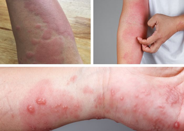 dị ứng thời tiết lạnh nổi mẩn đỏ